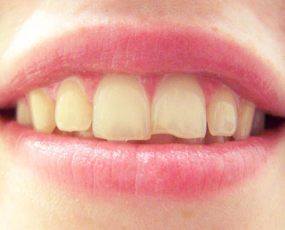 What Should I Do If I Chip My Tooth?