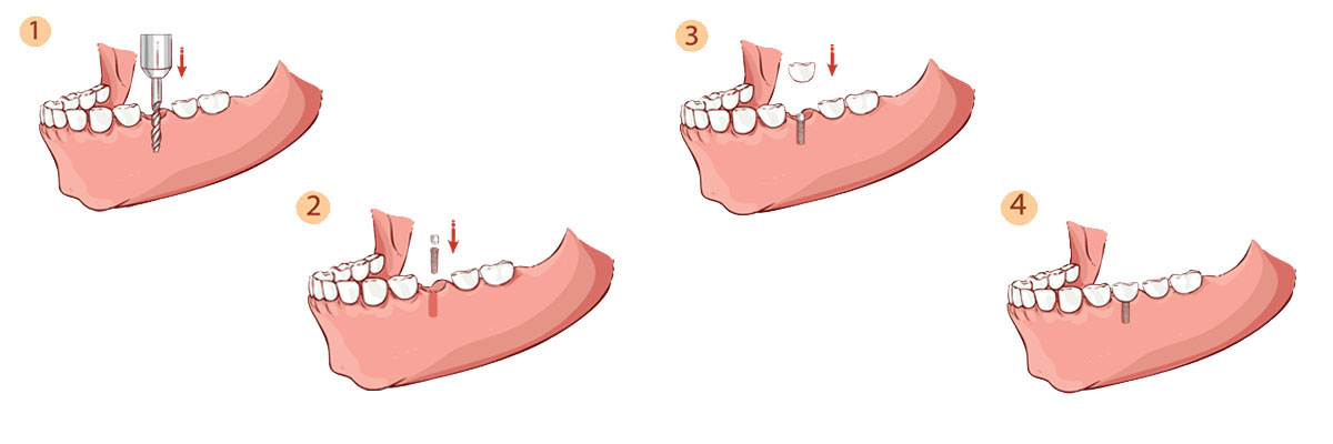 Edinburg Dental Implant Restoration