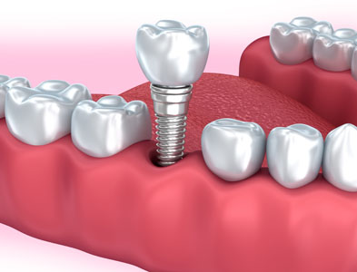 Getting A Dental Implant Restoration From McColl Dental Center