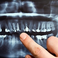 Full Mouth Reconstruction