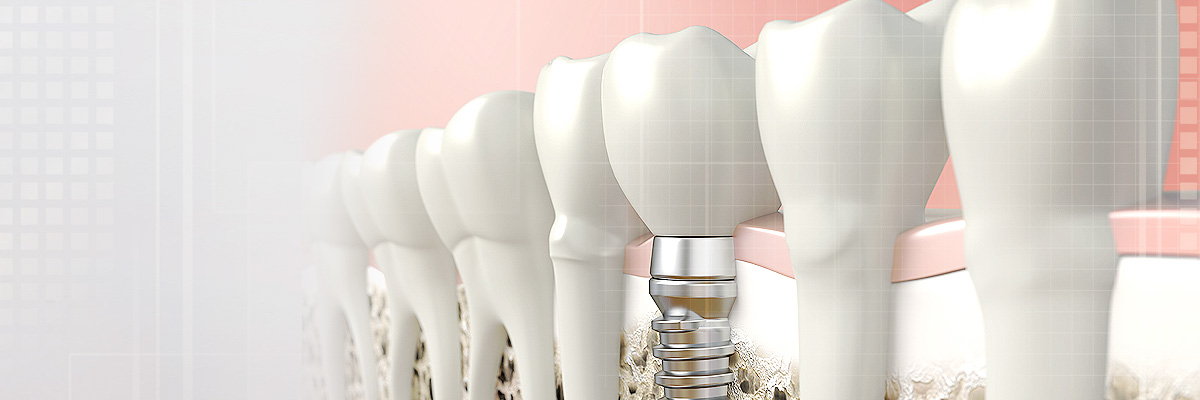 Edinburg Implant Dentist