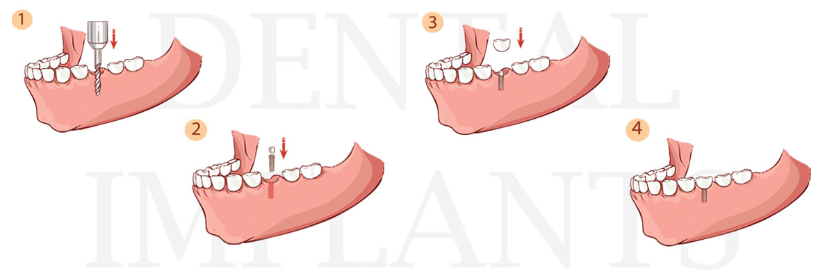 Edinburg The Difference Between Dental Implants and Mini Dental Implants