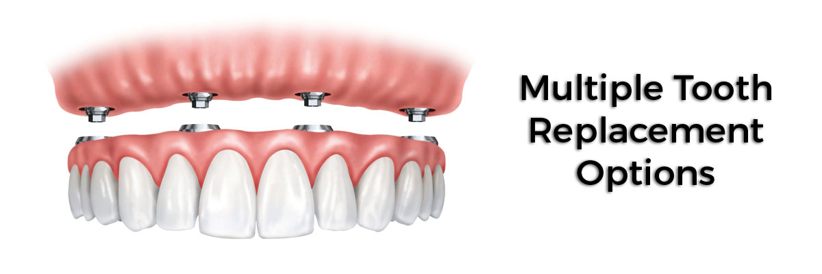 Edinburg Multiple Teeth Replacement Options