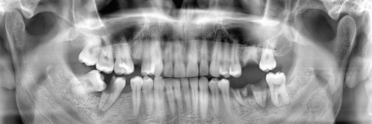 Edinburg Options for Replacing Missing Teeth